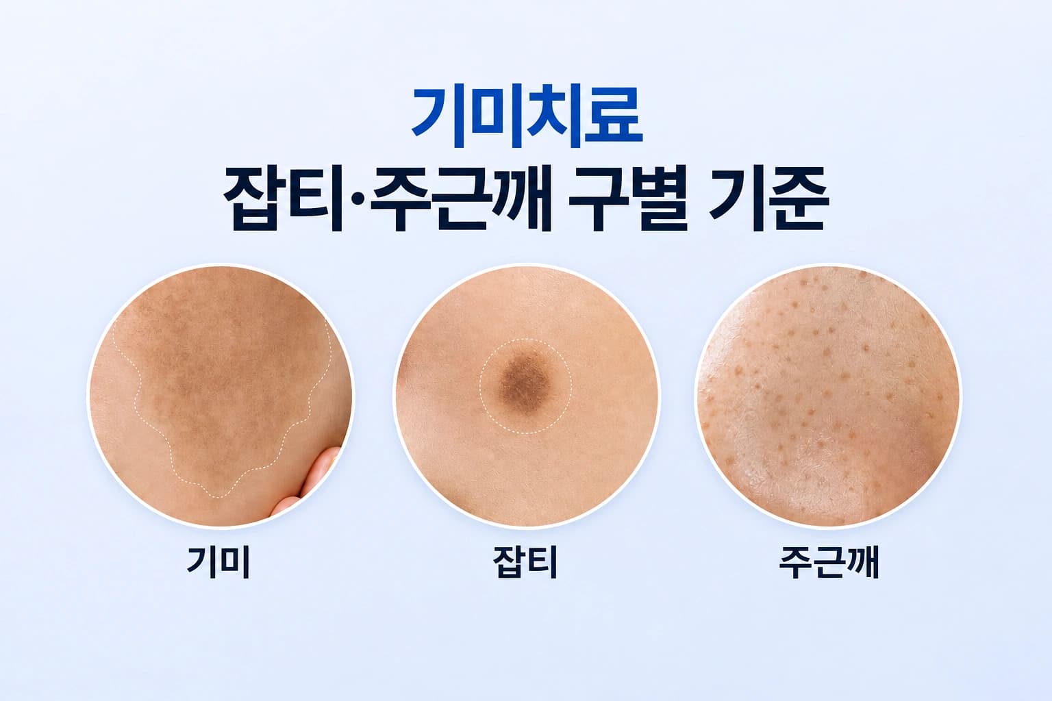 기미와 잡티, 주근깨의 색상과 경계, 분포 형태를 비교하고 기미치료 방법을 알려주는 컨텐츠 썸네일