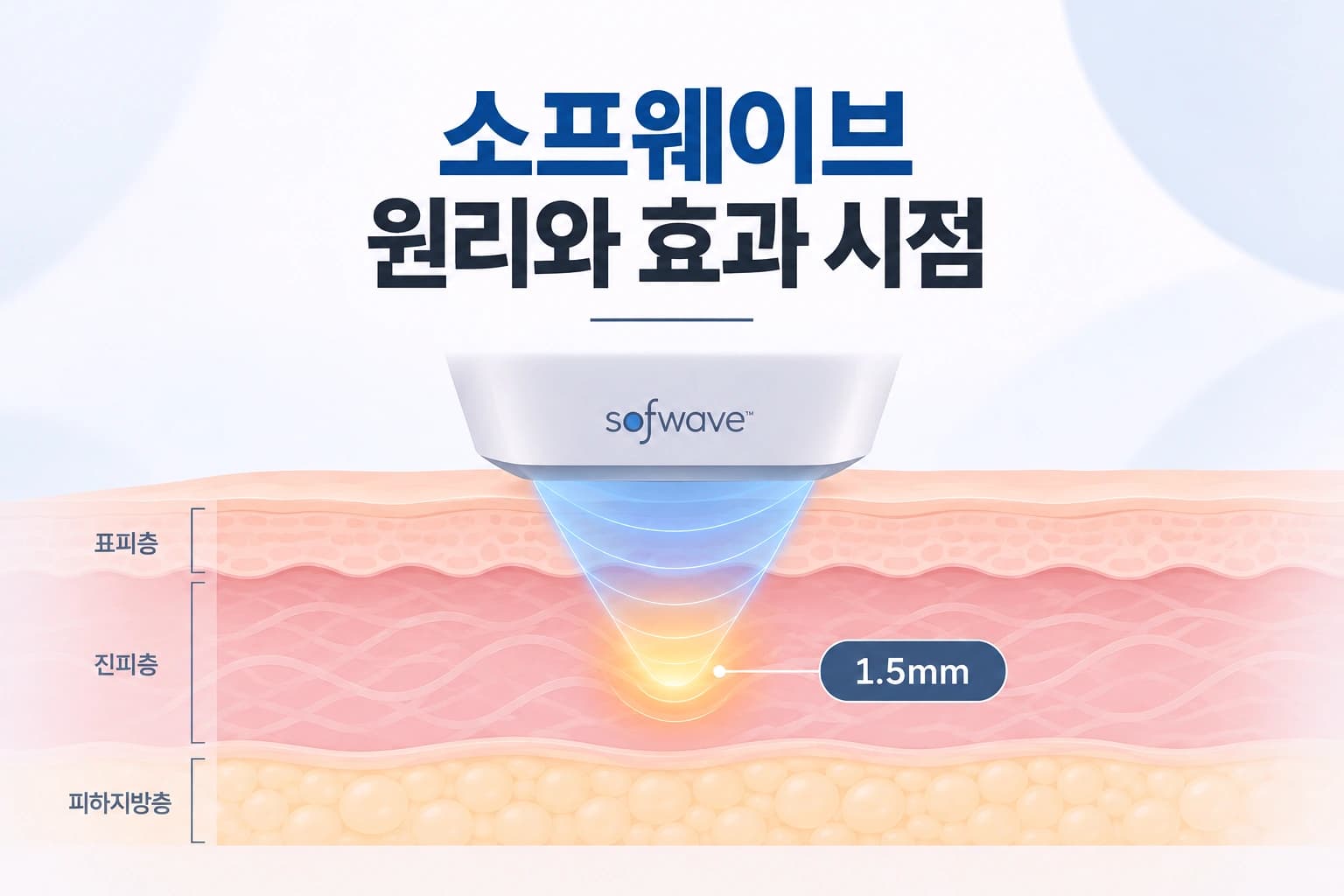 진피 1.5mm 깊이에 초음파 에너지를 전달하는 소프웨이브 원리 썸네일