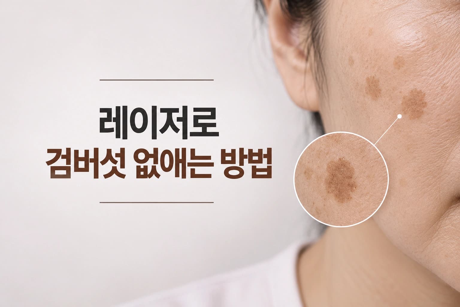 얼굴의 갈색 검버섯 병변을 확대해 보여주며 레이저로 검버섯 없애는 방법을 소개하는 컨텐츠 썸네일